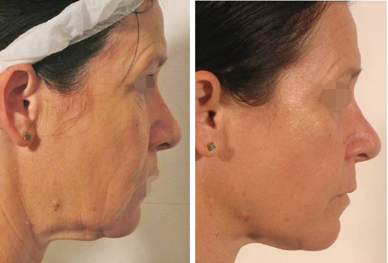 Lipofirm Before and Afters Lipofirm Before and Afters