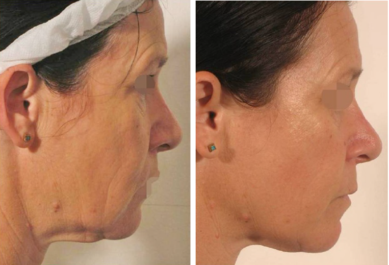 Lipofirm Pro face B&A2.PNG