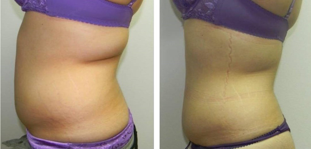 LipofirmPro before and after.jpg