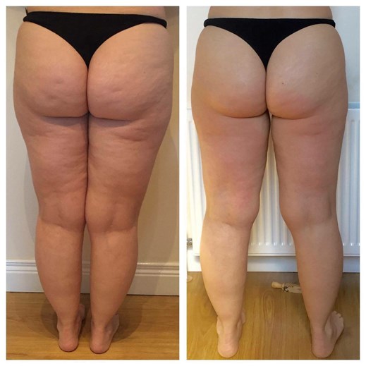 Lipofirm Pro B&A Legs.jpg