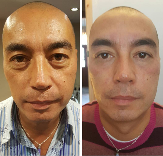 B&A_LipofirmPRO Facial.PNG