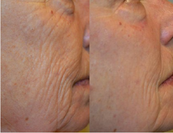 B&A_LipofirmPRO Facial2.PNG