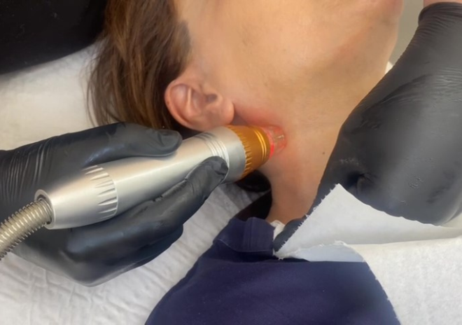 RF Micro Needling