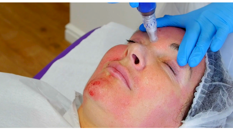 Microneedling