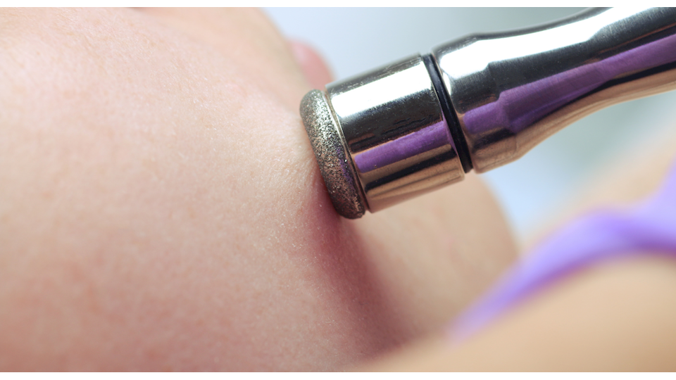 Microdermabrasion