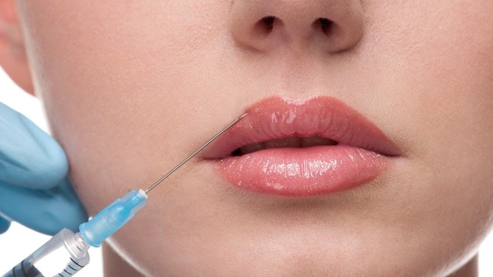 Lip Filler