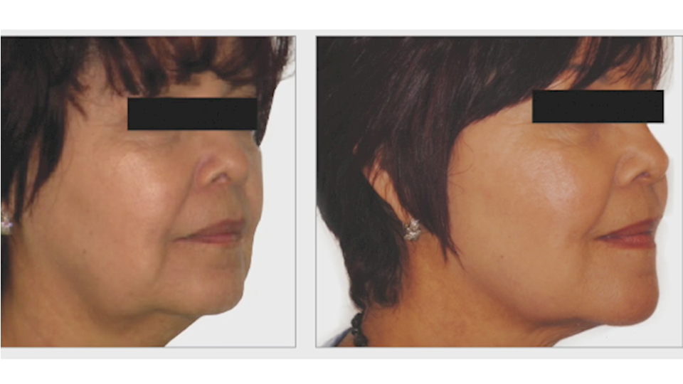 Skin Tightening