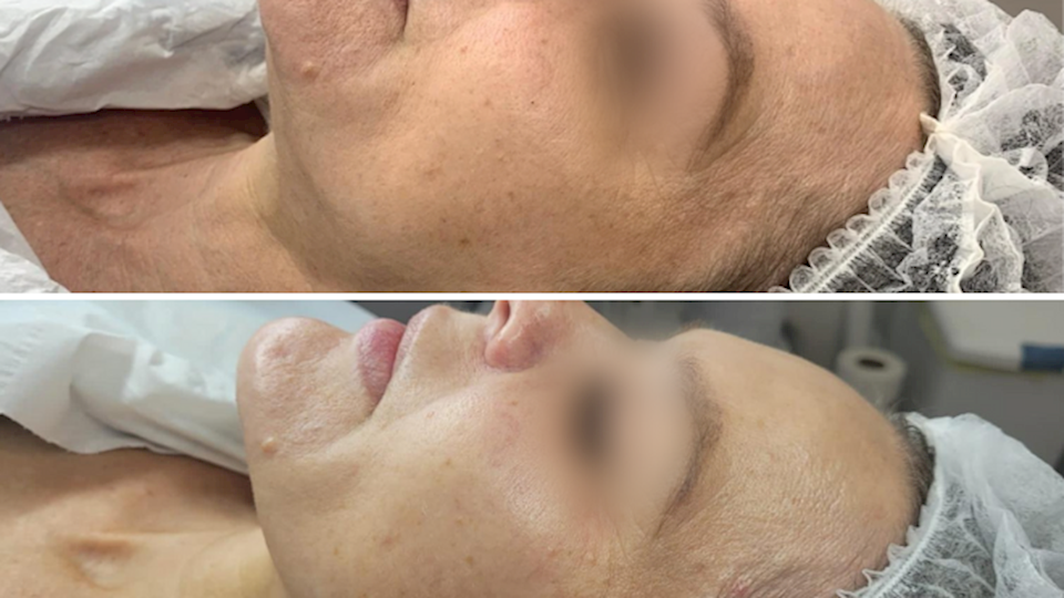 Radio Frequency Micro Needling